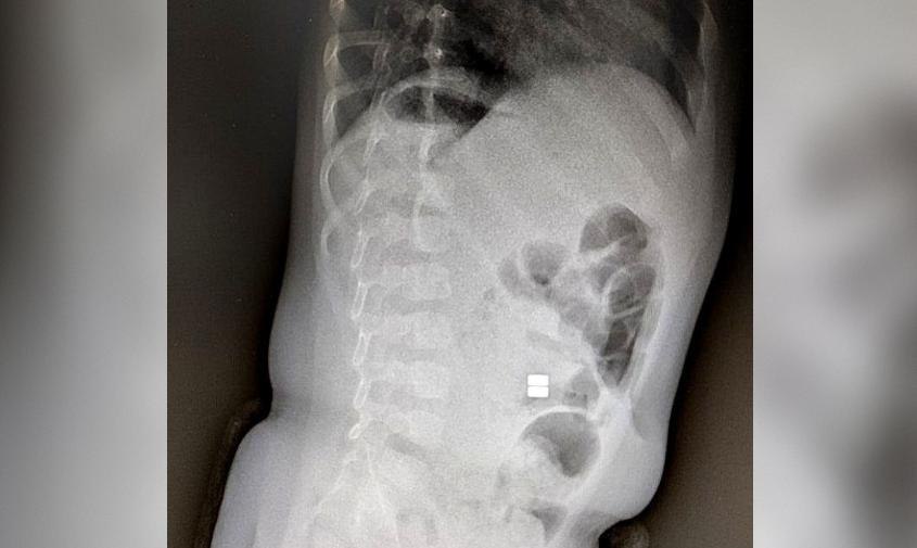 Врачи бьют тревогу: маленькие амурчане все чаще попадают на операционный стол, проглотив магнитные шарики