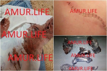 «Ребенку сделали уже три операции»: школьница, которую в Свободном ранил из ружья бизнесмен, до сих пор не оправилась от случившегося