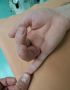 Амурские хирурги выполнили успешную пересадку пальцев кисти у пациента после тяжелой травмы циркулярной пилой